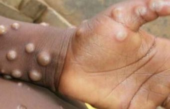 ମଙ୍କି ପକ୍ସ ପାଇଁ ପ୍ରସ୍ତୁତ ରୁହ